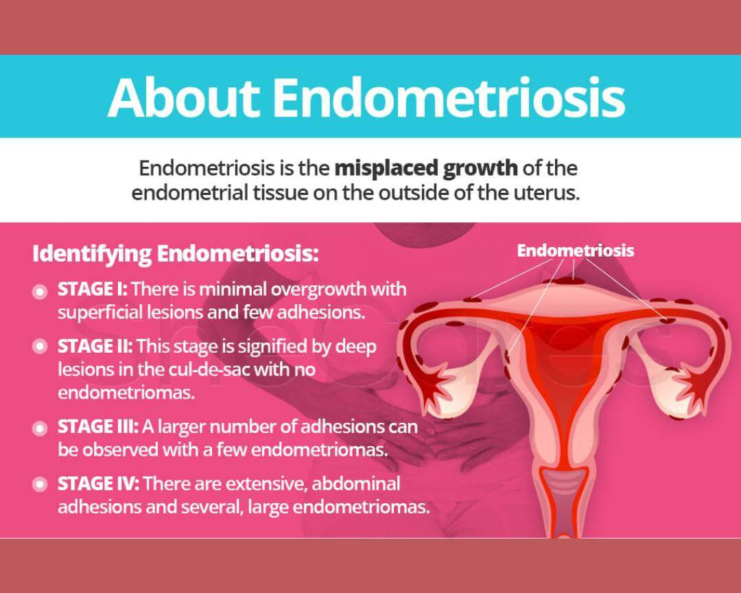 Understanding the Differences Between Endometriosis and PCOS - Eco Period Australia